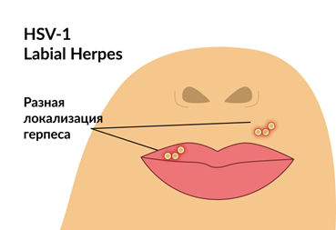 HSV-1 Labial Herpes