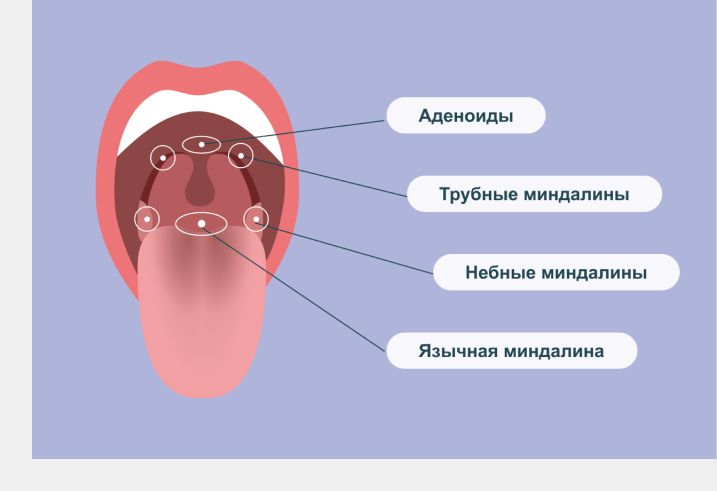 Pin on Medicine Lingual tonsils, Tonsil stones, Human body projects